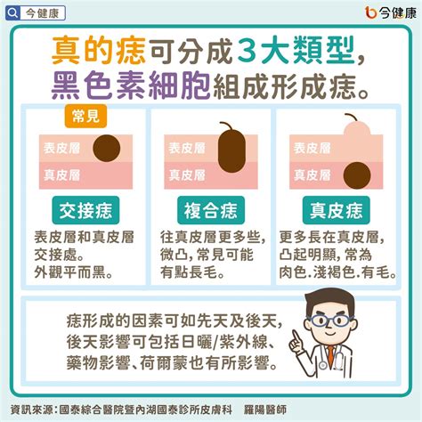 腳背突然長痣|是痣？皮膚癌？還是什麼？常見Q&A解惑！醫教揪出「。